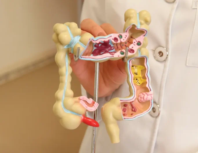 Modelo de Câncer Colorretal