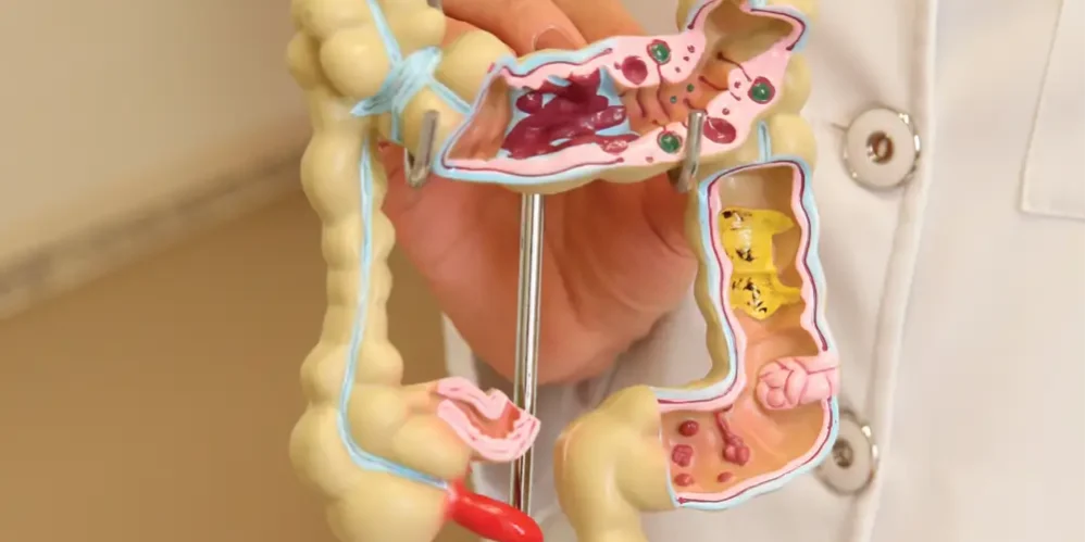 cancer_colorretal Modelo de Câncer Colorretal