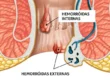 o-que-e-hemorroida