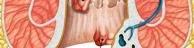 o-que-e-hemorroida? o-que-e-hemorroida