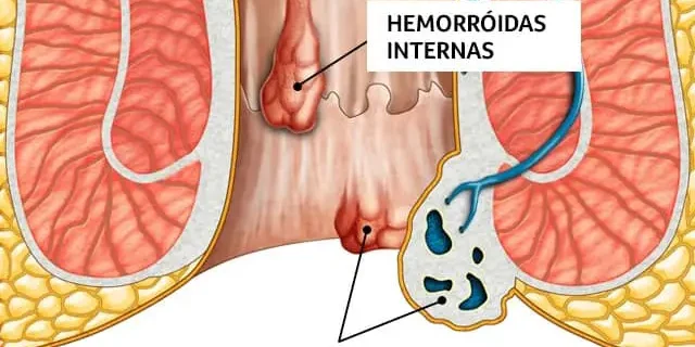 o-que-e-hemorroida? o-que-e-hemorroida
