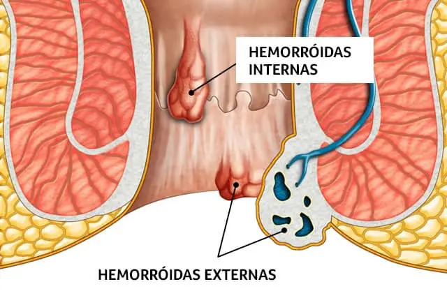 o-que-e-hemorroida