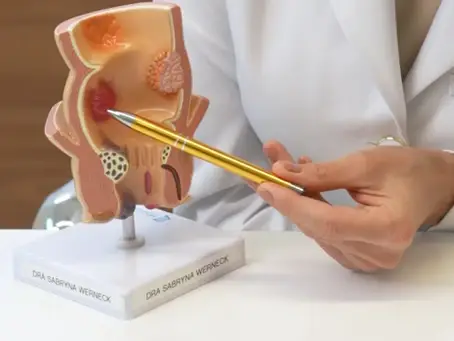 Dra. Sabryna mostra o que são Pólipos Intestinais