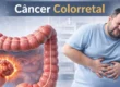 Câncer Colorretal