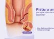 Imagem ilustrativa de fístula anal com trajeto interno que impede a cicatrização espontânea