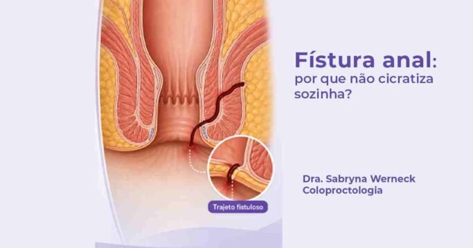 Imagem ilustrativa de fístula anal com trajeto interno que impede a cicatrização espontânea