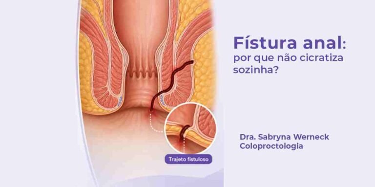 Imagem ilustrativa de fístula anal com trajeto interno que impede a cicatrização espontânea