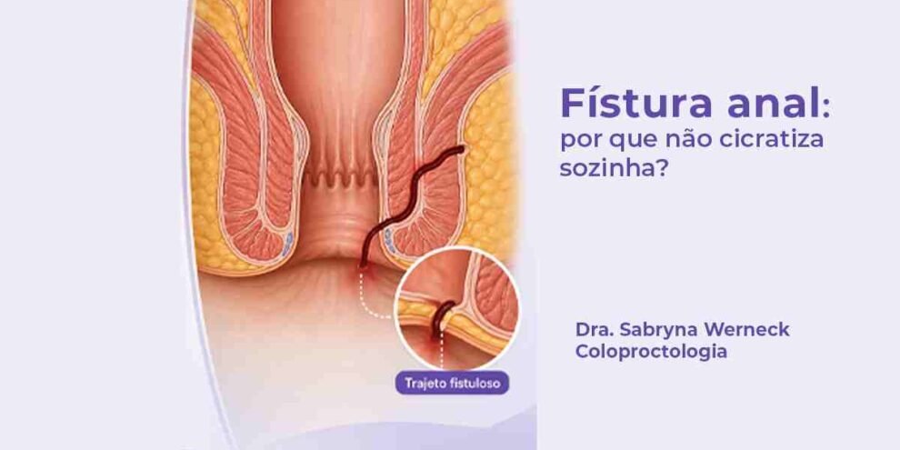 Imagem ilustrativa de fístula anal com trajeto interno que impede a cicatrização espontânea