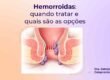 Hemorroidas internas e externas com indicação de quando tratar e opções de tratamento