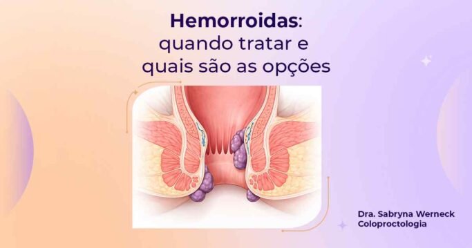 Hemorroidas internas e externas com indicação de quando tratar e opções de tratamento