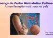 Doença de Crohn Metastática Cutânea