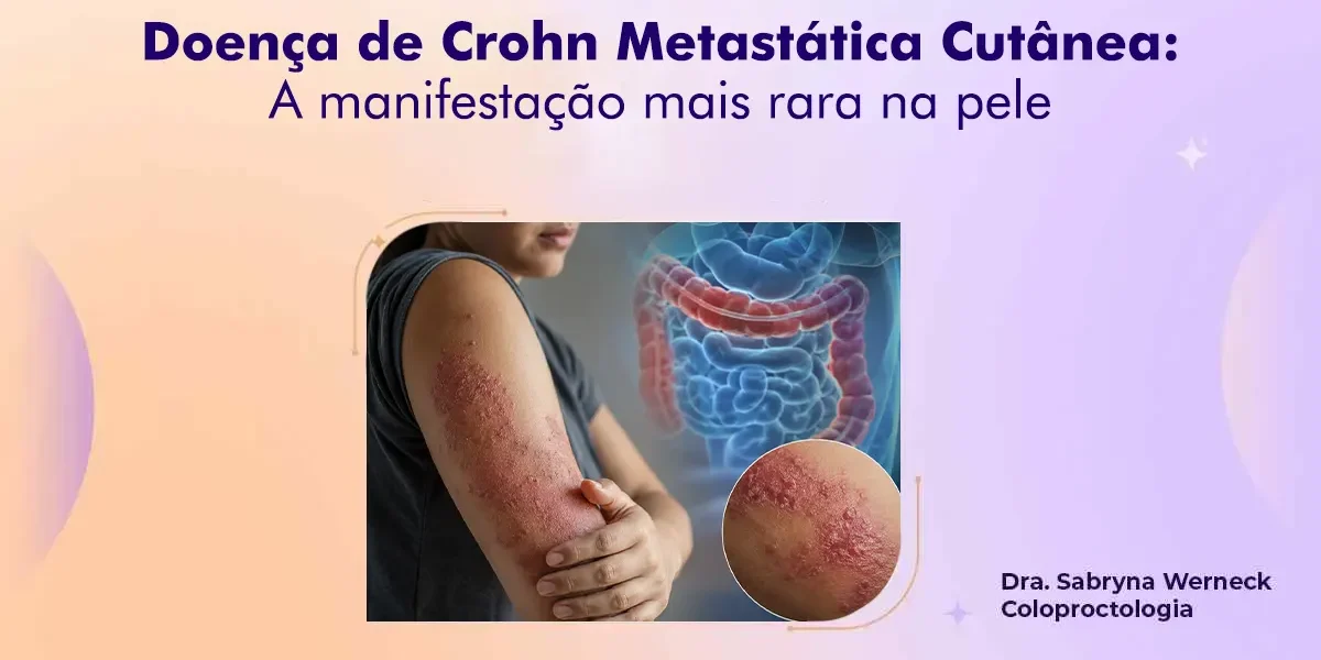 Doença de Crohn Metastática Cutânea