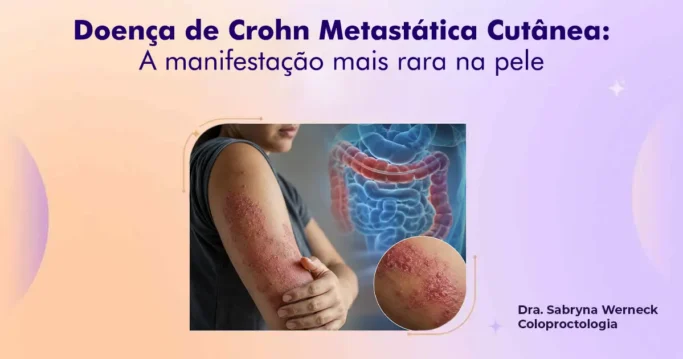 Doença de Crohn Metastática Cutânea
