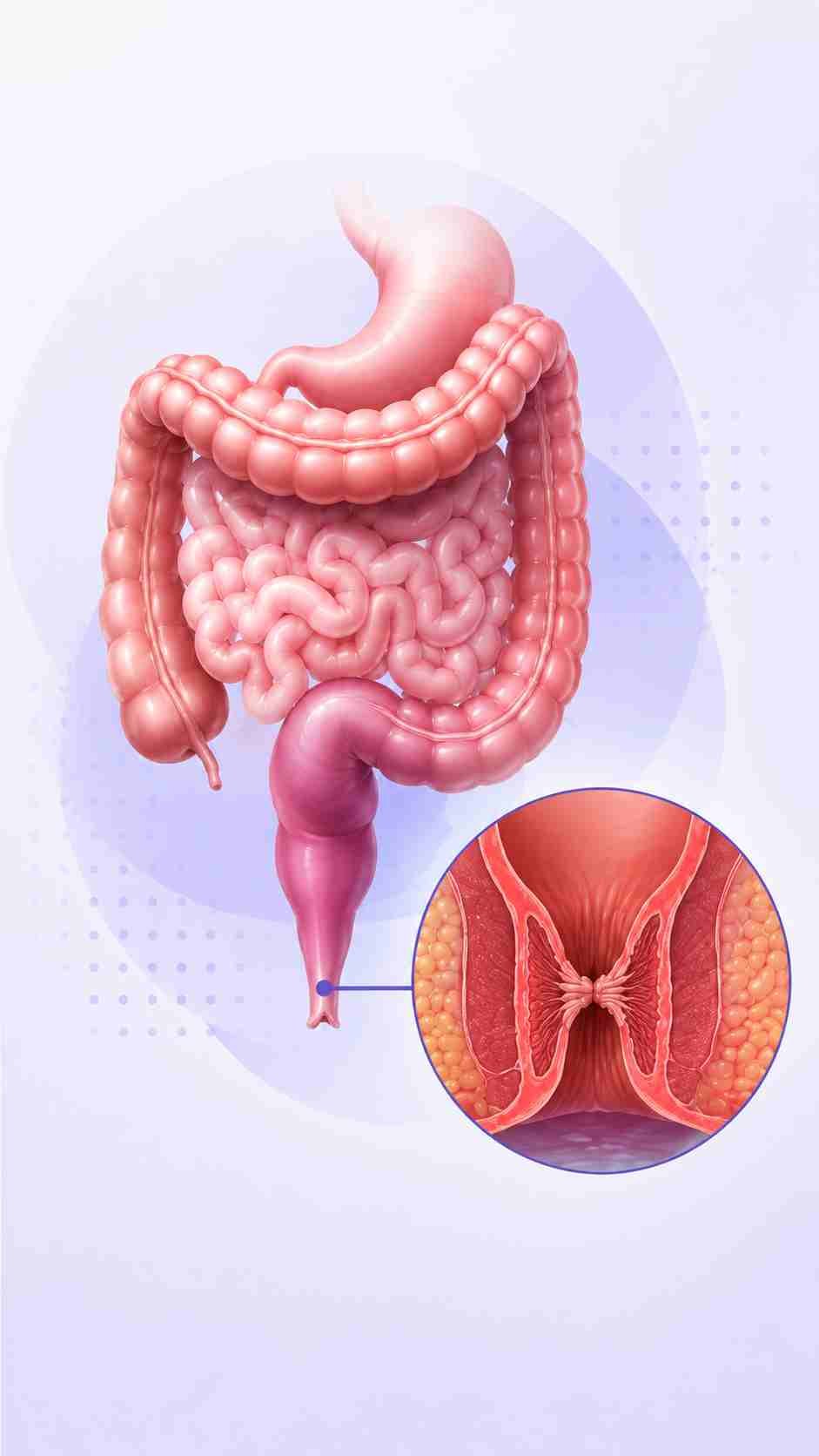Estenose anal associada à Doença de Crohn