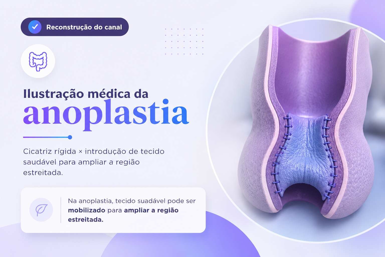Ilustração do princípio da anoplastia com tecido saudável ampliando a região estreitada