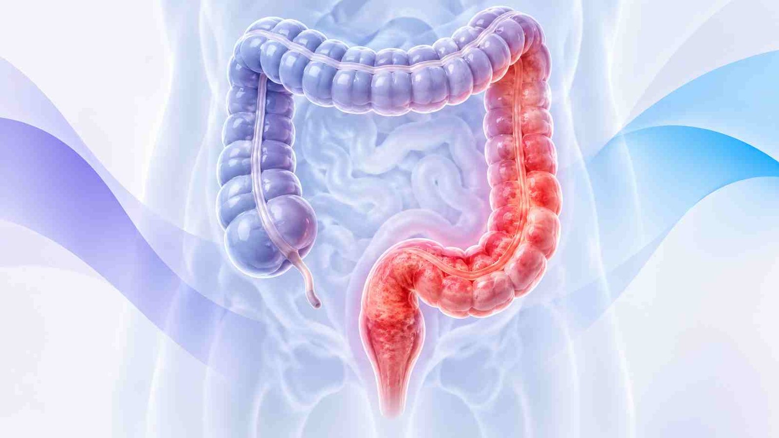Ilustração médica do cólon e reto mostrando áreas afetadas pela retocolite ulcerativa