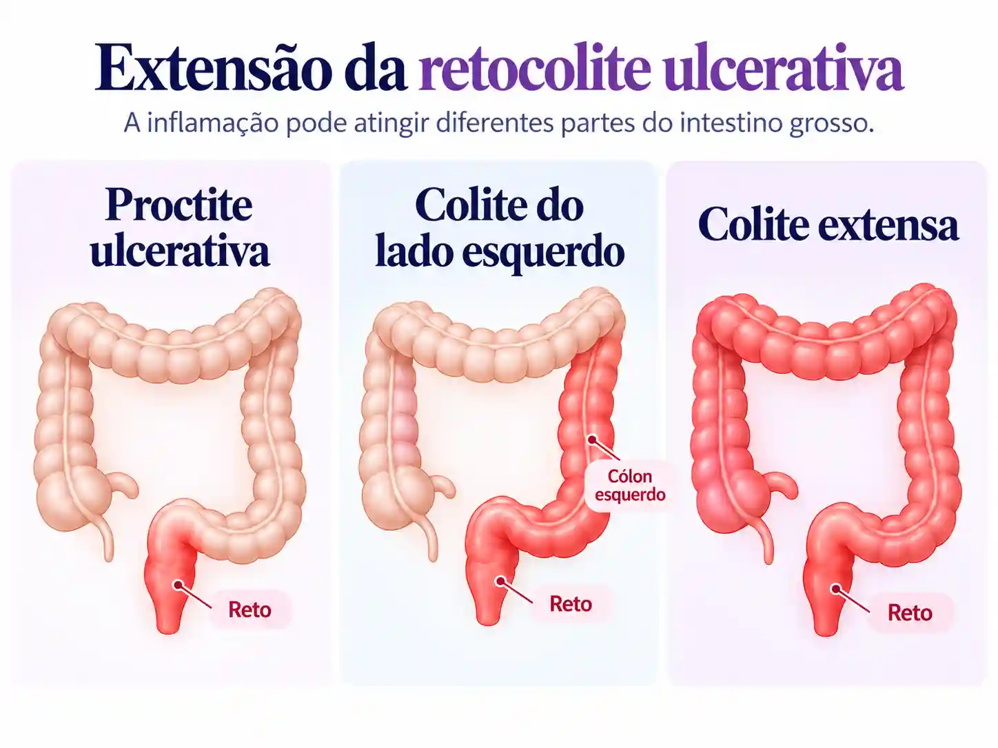 Infográfico comparando três extensões da retocolite ulcerativa: proctite ulcerativa restrita ao reto, colite do lado esquerdo envolvendo reto e cólon esquerdo, e colite extensa atingindo regiões mais amplas do intestino grosso.